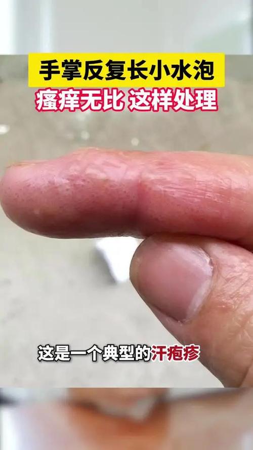 手上长这种透明小水疱,千万别挑破!