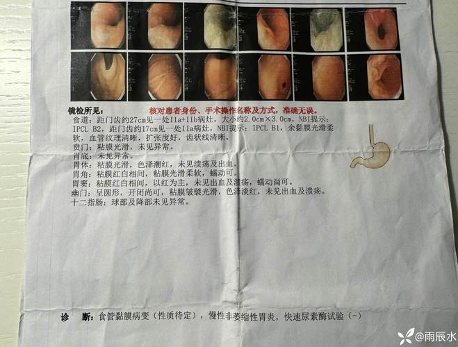 高发恶性食管癌竟是“烫”出来的?