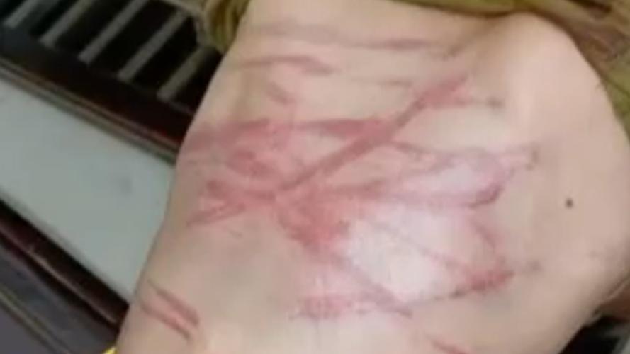 一钻进被窝就发作,身上出现道道“血痕”!最近杭州人扎堆看皮肤科,什么情况?