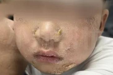 碰一下钻心疼!吃火锅烫嘴后竟全身溃烂,医生警告:有传染性