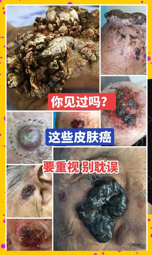 阿姨脸上有破口,一查是癌症!身上长出这东西,千万警惕