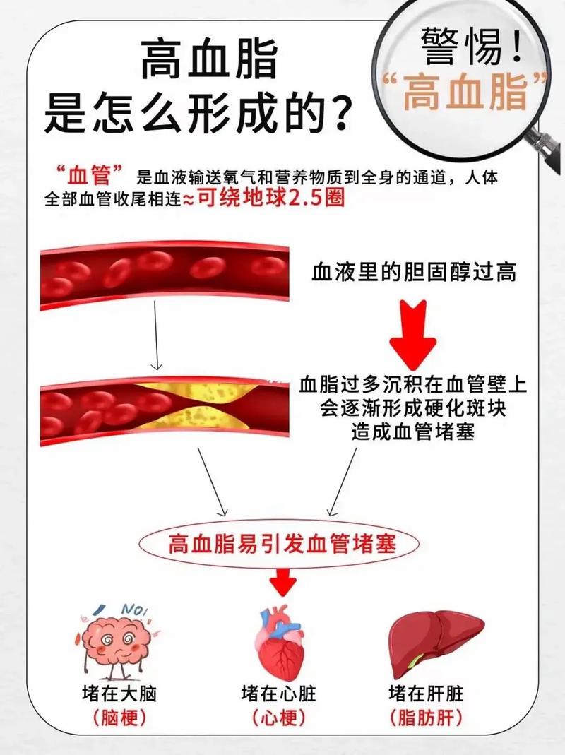 这种特殊的高血脂,“加速”血管病发生,还会“传染”给家人!