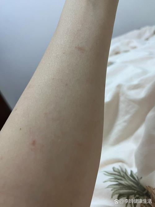 确诊了!浙江一女子手臂上都是小红点!密密麻麻……